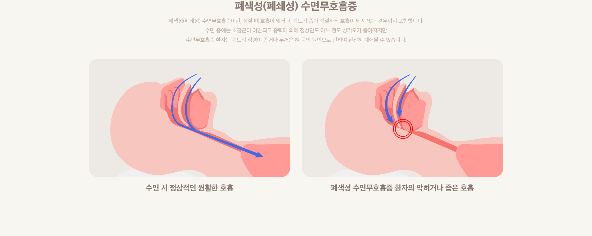 폐색성폐쇄성 수면무호흡증