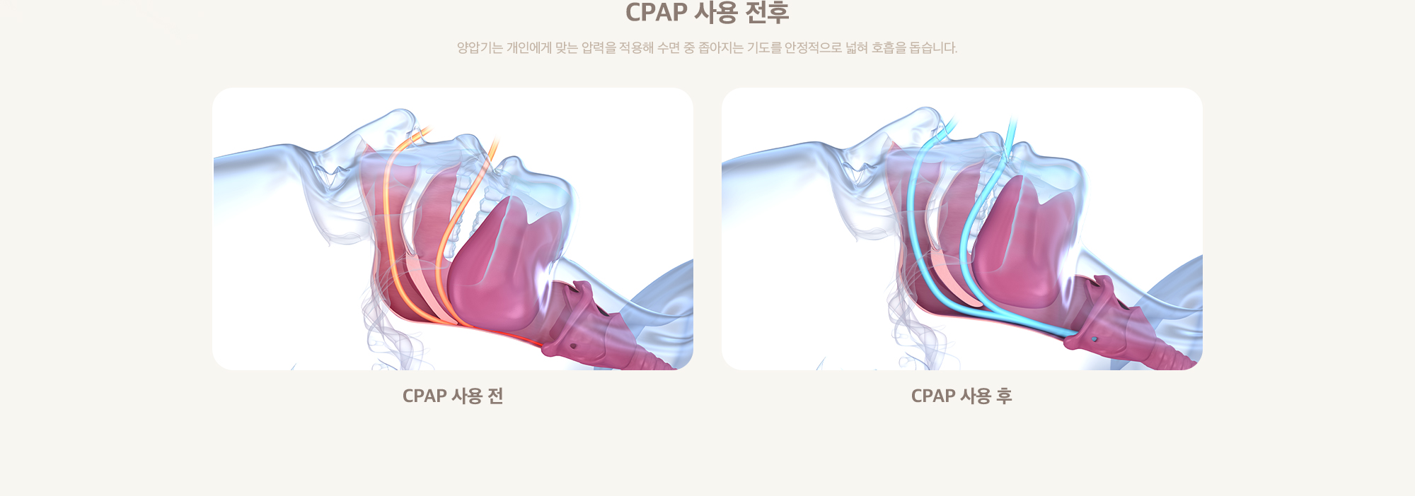 CPAP 사용 전후